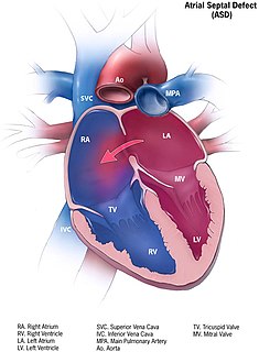 Atrial septal defect Human Heart defect present at birth