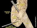 Ileo-cecal valve