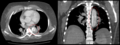 Chest CT with descending (type B Stanford) aortic dissection (red circle)