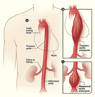 <span class="mw-page-title-main">Aortic aneurysm</span> Excessive enlargement of the human aorta