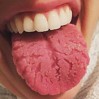 <span class="mw-page-title-main">Fissured tongue</span> Medical condition