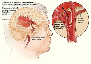 <span class="mw-page-title-main">Internal bleeding</span> Medical condition