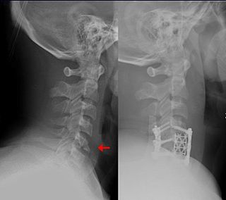 <span class="mw-page-title-main">Orthopedic surgery</span> Branch of surgery concerned with the musculoskeletal system