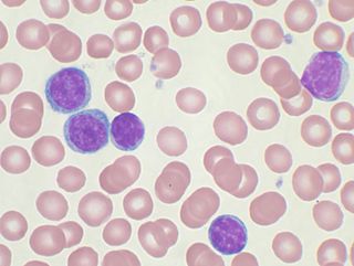 <span class="mw-page-title-main">Chronic lymphocytic leukemia</span> Medical condition