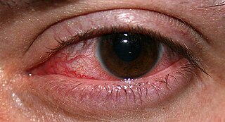 <span class="mw-page-title-main">Keratitis</span> Inflammation of the cornea of the eye