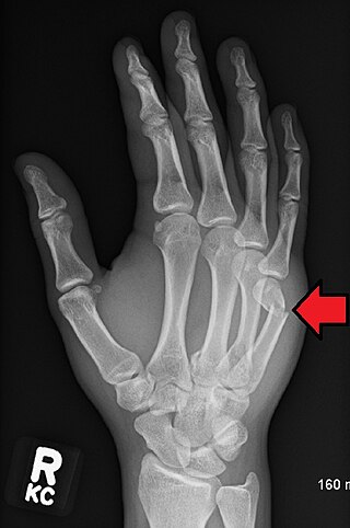 <span class="mw-page-title-main">Boxer's fracture</span> Break of the fifth metacarpal bone of the hand near the knuckle