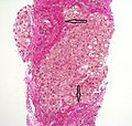 Histopathology of steatohepatitis with established cirrhosis, with thick bands of fibrosis (Van Gieson's stain)[92]