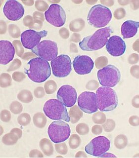 Precursor B-cell lymphoblastic leukemia