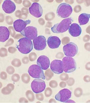 Leucemia