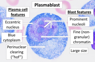 <span class="mw-page-title-main">Plasmablastic lymphoma</span> Type of large B-cell lymphoma