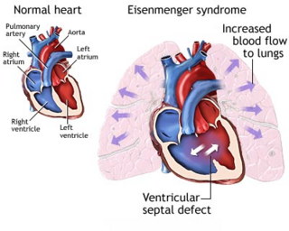 <span class="mw-page-title-main">Eisenmenger syndrome</span> Medical condition