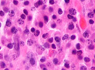 <span class="mw-page-title-main">Tumors of the hematopoietic and lymphoid tissues</span> Tumors that affect the blood, bone marrow, lymph, and lymphatic system