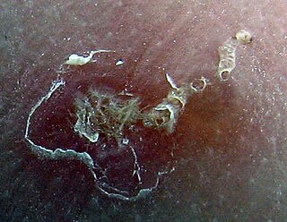 <span class="mw-page-title-main">Scabies</span> Human disease