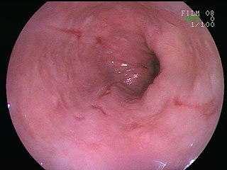 <span class="mw-page-title-main">Esophagitis</span> Medical condition