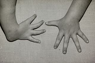 <span class="mw-page-title-main">Radial dysplasia</span> Medical condition