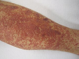 Cutaneous small-vessel vasculitis Medical condition