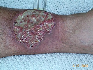 Pyoderma gangrenosum Medical condition