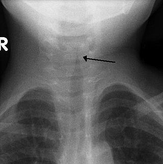 <span class="mw-page-title-main">Croup</span> Respiratory infection often caused by a virus