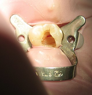 <span class="mw-page-title-main">Root canal treatment</span> Dental treatment