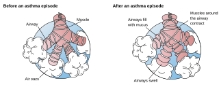 <span class="mw-page-title-main">Bronchospasm</span> Lower respiratory tract disease that affects the airways leading into the lungs