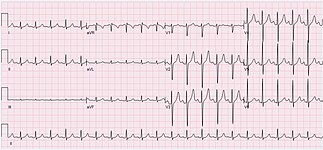 ECG of a 29-year-old female with sinus tachycardia