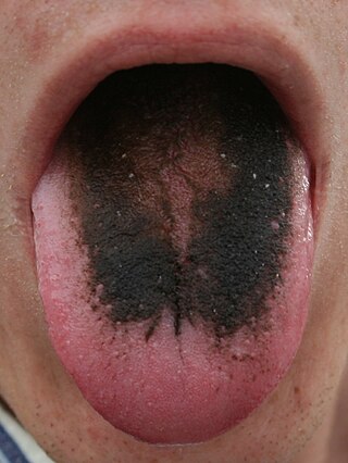 <span class="mw-page-title-main">Tongue disease</span> Medical condition