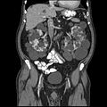 Abdominal CT scan of an adult with autosomal dominant polycystic kidney disease: Extensive cyst formation is seen over both kidneys, with a few cysts in the liver, as well. (Coronal plane)