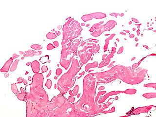 <span class="mw-page-title-main">Primary tumors of the heart</span> Medical condition