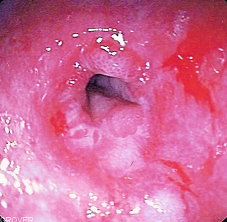 <span class="mw-page-title-main">Esophageal stricture</span> Medical condition