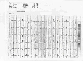 ECG of a patient with Ostium primum ASD ASDPrimum.jpg