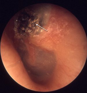 Cholesteatoma Medical condition