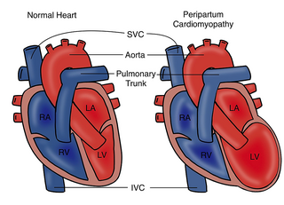 <span class="mw-page-title-main">Peripartum cardiomyopathy</span> Medical condition