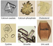 Urine crystals comparison, with calcium phosphate crystal depicted at top center.