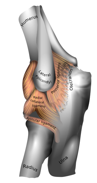 <span class="mw-page-title-main">Tennis elbow</span> Condition in which the outer part of the elbow becomes sore and tender