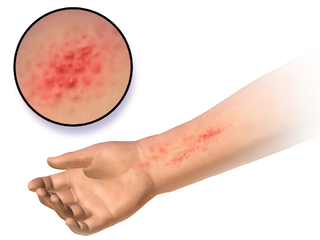 <span class="mw-page-title-main">Allergic contact dermatitis</span> Medical condition