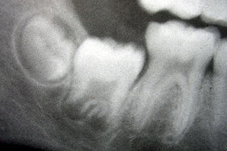 Human tooth development process by which teeth form