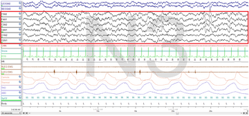 Stage 3 Sleep. EEG highlighted by red box.