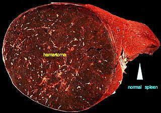 <span class="mw-page-title-main">Hamartoma</span> Tumour-like overgrowth due to a systemic genetic condition