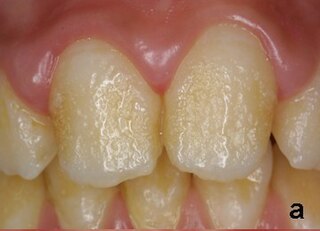 <span class="mw-page-title-main">Pitting enamel hypoplasia</span>