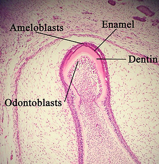 <span class="mw-page-title-main">Ameloblastic fibroma</span> Medical condition