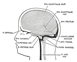 <span class="mw-page-title-main">Cerebral venous sinus thrombosis</span> Presence of a blood clot in the dural venous sinuses or cerebral veins