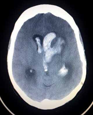 <span class="mw-page-title-main">Intracerebral hemorrhage</span> Type of intracranial bleeding that occurs within the brain tissue itself