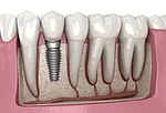 Thumbnail for Dental implant