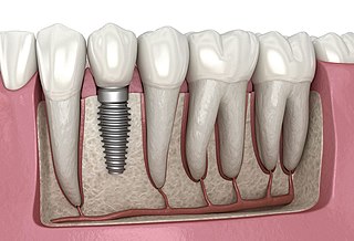 <span class="mw-page-title-main">Dental implant</span> Surgical component that interfaces with the bone of the jaw