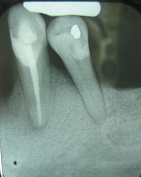 This X-ray film displays two lone-standing mandibular teeth, #21 and #22: the lower left first premolar and canine, exhibiting severe bone loss of 30-50%. Widening of the PDL surrounding the premolar is likely due to secondary oclcusal trauma. Periodontalboneloss.JPG