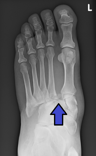 <span class="mw-page-title-main">Lisfranc injury</span> Type of fracture/dislocation injury of the foot