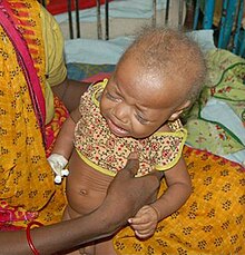 Menkes disease showing symptoms of the sparse, steel colored "kinky hair" and paleness Menkes disease4.jpg