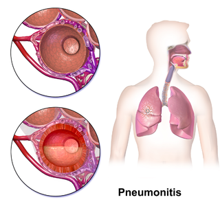 <span class="mw-page-title-main">Pneumonitis</span> General inflammation of lung tissue