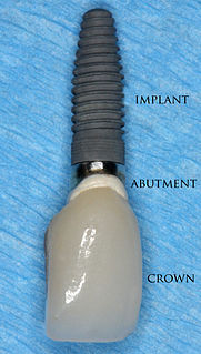 Dental implant surgical component that interfaces with the bone of the jaw or skull to support a dental prosthesis.