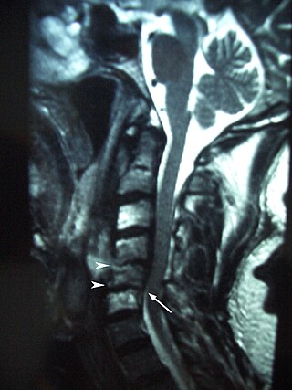 <span class="mw-page-title-main">Osteoradionecrosis</span> Osteoradionecrosis is an Acute form of Osteomyelitis